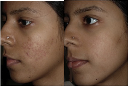 Hyperpigmentation-Reduction-with-CIT-Before-and-After