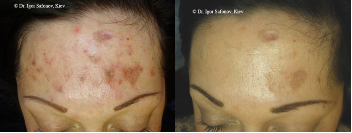 Hyperpigmentation-Reduction-with-CIT-Before-and-After