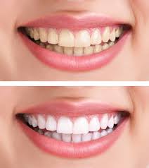 Teeth-Whitening-Before-and-After (Copy)