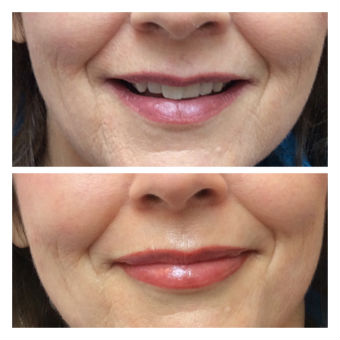 Lip-Pigmentation-Enhancement-Before-and-After