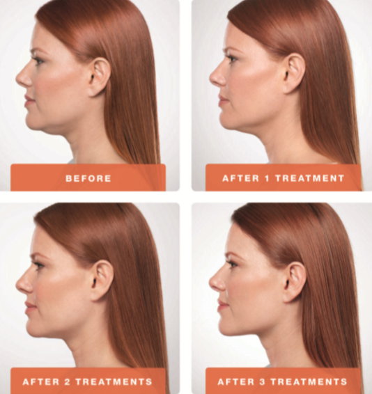 Belkyra-Double-Chin-Treatment-Before-and-After