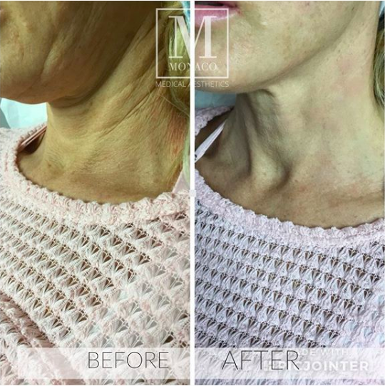 Threadlift-with-Absorbable-Sutures-Before-and-After