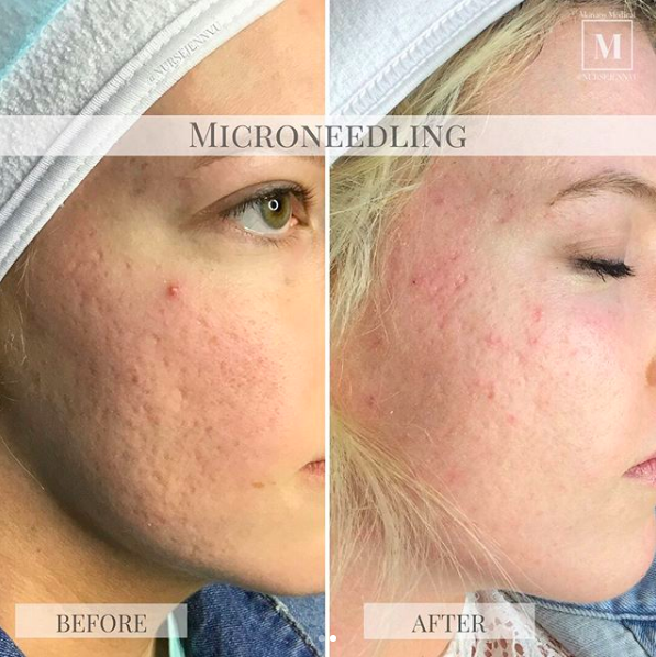 Hyperpigmentation-Reduction-with-CIT-Before-and-After