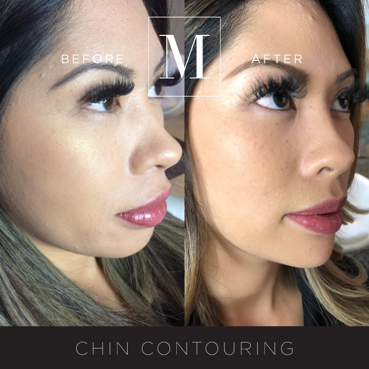 DERMAL_Chin-Contouring-BA1.jpg