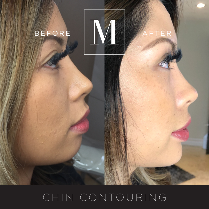 DERMAL_Chin-Contouring-BA2.jpg