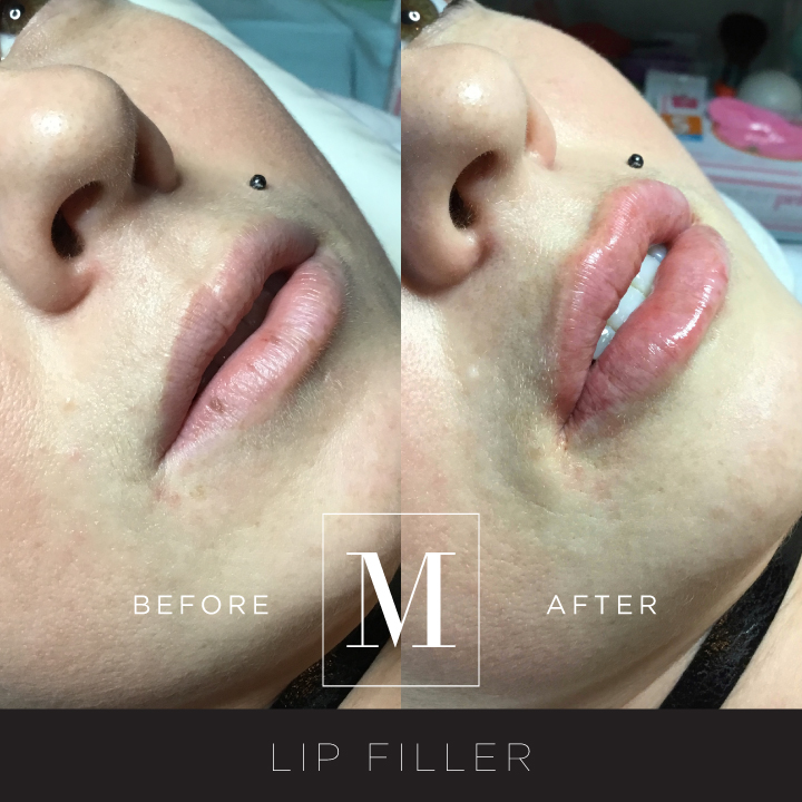 DERMAL_Lips-BA1.jpg