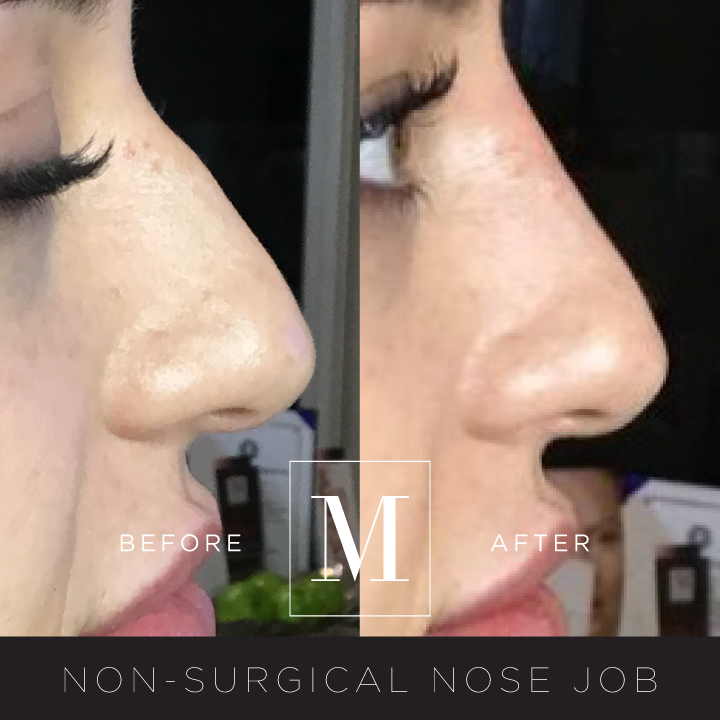 DERMAL_Nose-Filler-BA1.jpg