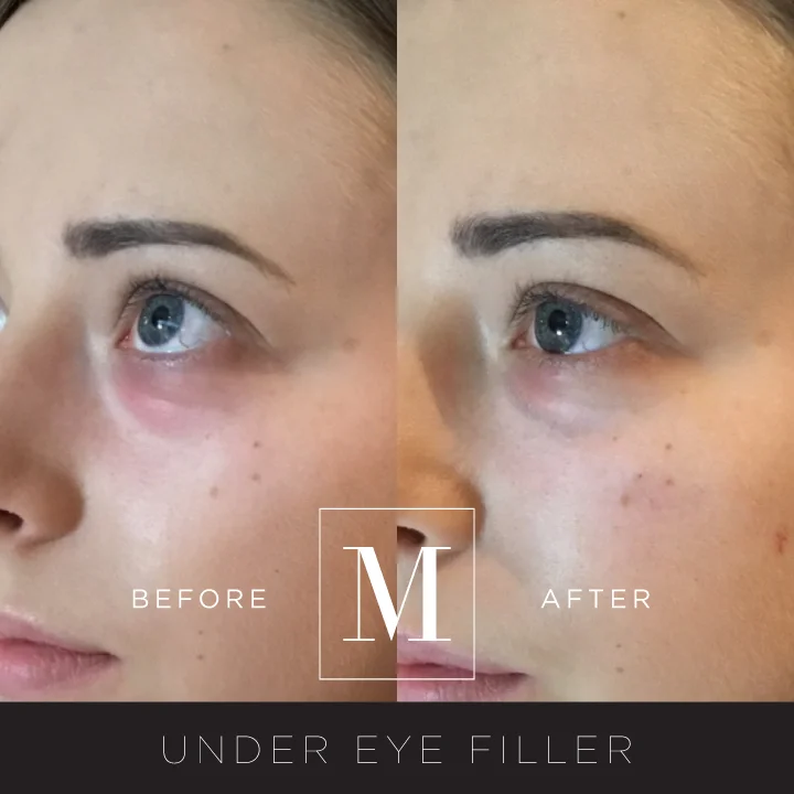 Lip and Facial Augmentation with Dermal Fillers — Monaco Medical Aesthetics