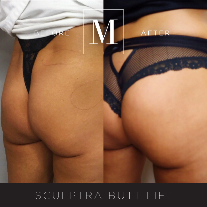 SCULPTRA_Butt-BA5.jpg