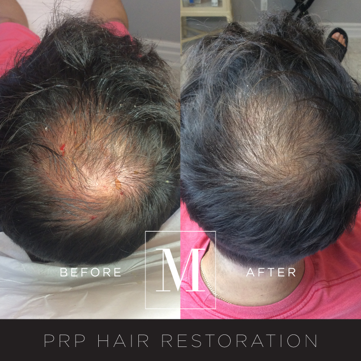 PRP_Hair-BA2.jpg