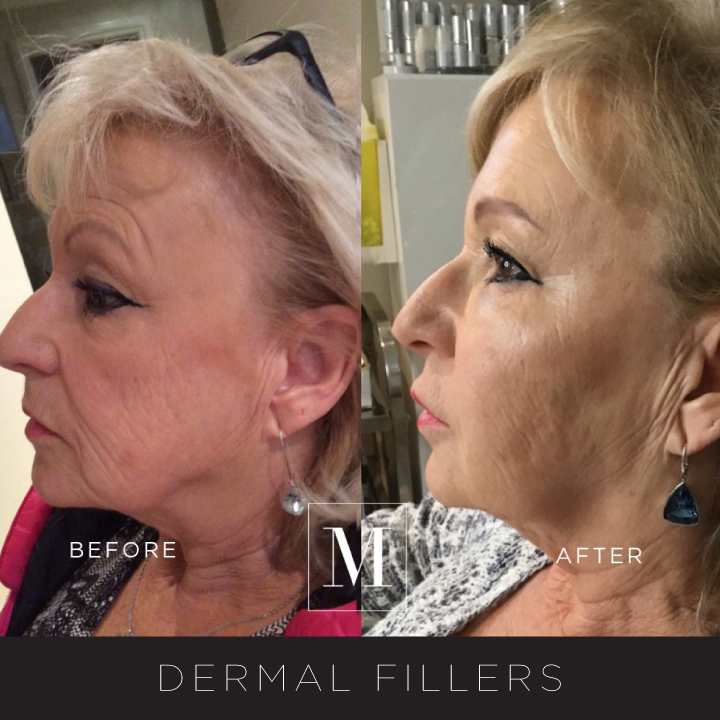 Dermal-Fillers-BA21.jpg