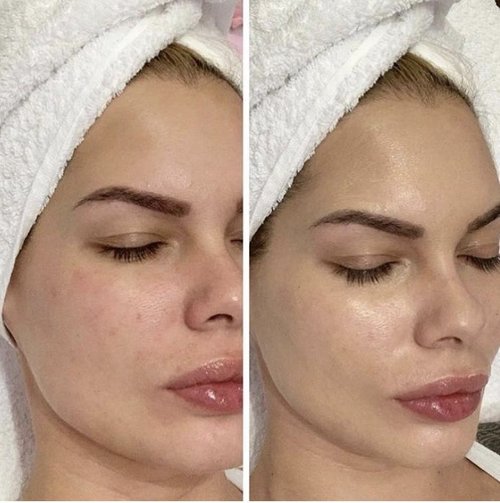 glutathione microneedling before and after WHITENING GLUTATHION MESO COCKTAIL  leaderma