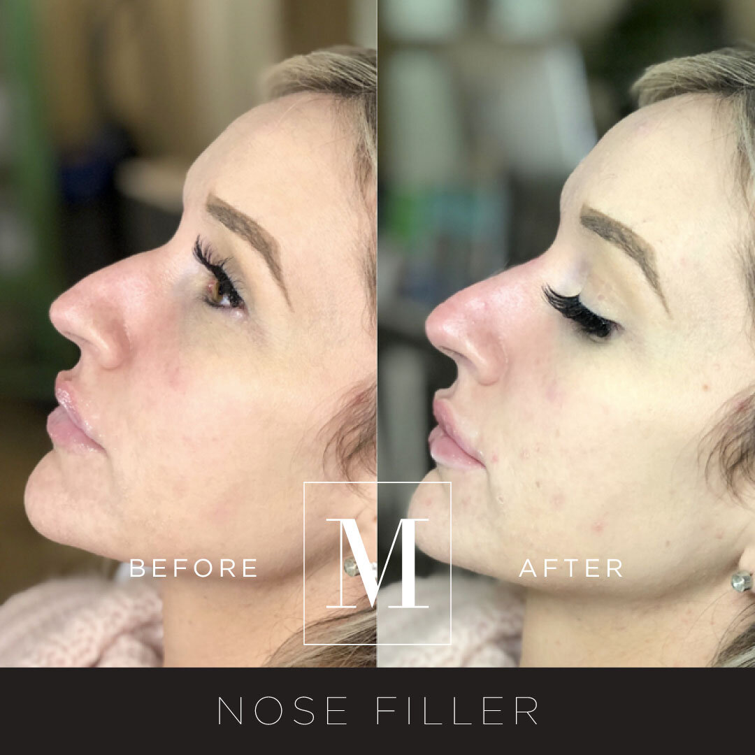 Nose-Filler-BA.jpg