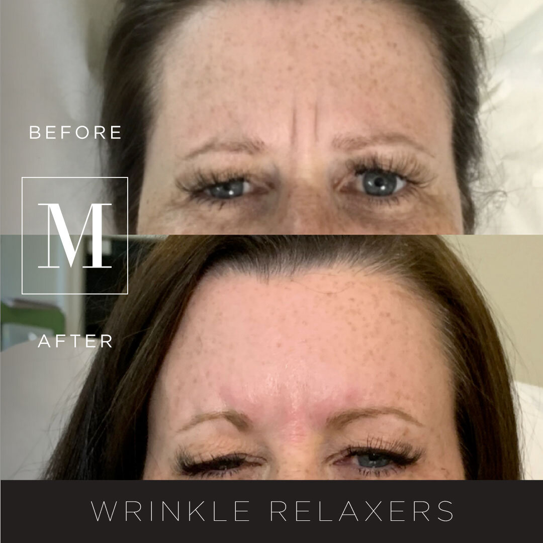 Wrinkles-BA1.jpg