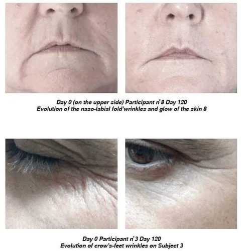 glutathione clinic in hyderabad Glutathione IV Treatment in Hyderabad