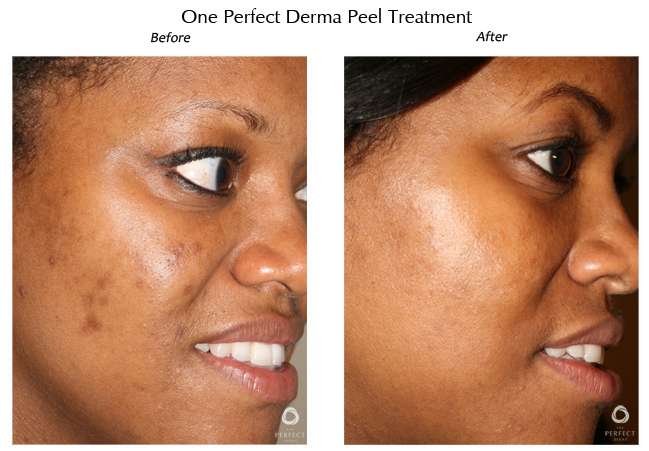 dermapeel-before-after-2.png