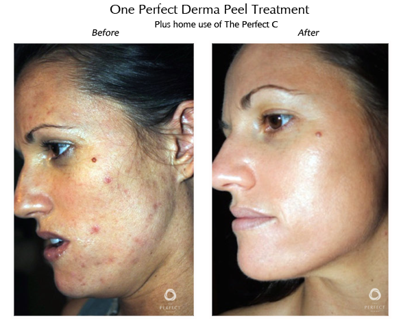 dermapeel-before-after-4.png