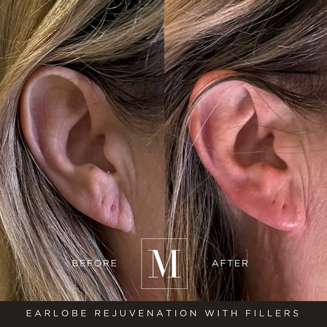 Beautiful results by @nurselina.monaco 💕💕

DID YOU KNOW YOU CAN DO EARLOBE FILLER? If you&rsquo;ve worn a lot of heavy jewelry in your lifetime, suffer from lax skin and volume loss on the earlobes, dermal filler can be a great way to easily improv