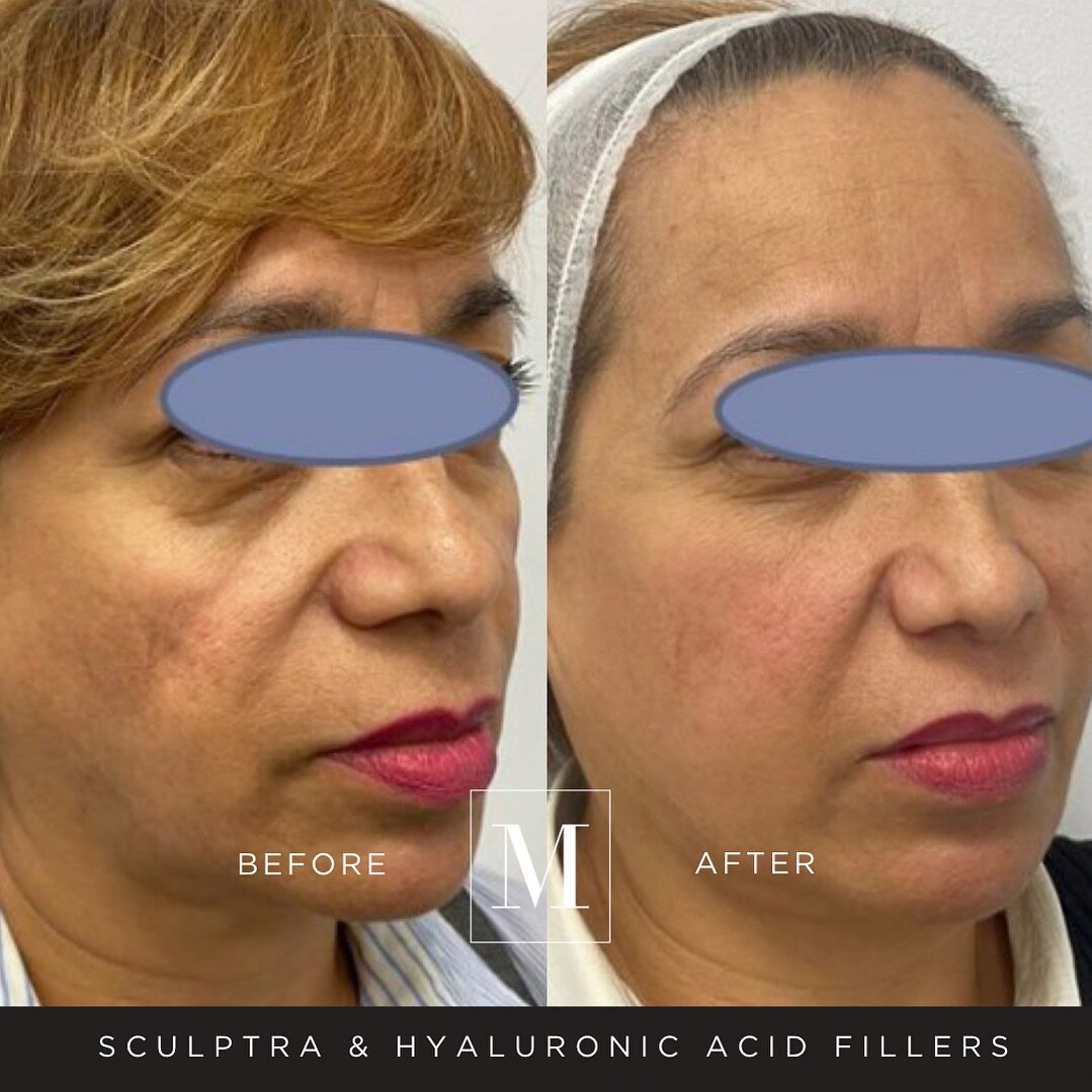 Facial Rejuvenation Combo 💕💕

HA fillers are often used to plump up the lips, cheeks, and tear troughs, as well as to fill in wrinkles and fine lines around the nose and mouth. 

Sculptra, on the other hand, is often used to promote collagen to the