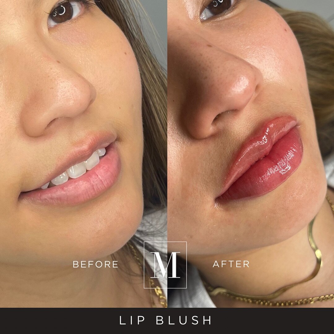 NOW OFFERING LIP BLUSH 🔥

An excellent add-on or alternative with lip filler 💕. This month we are offering it 50 percent OFF!

If you&rsquo;re obsessed with the effect lip tints give (aka an effortless touch of color that won&rsquo;t smudge), then 