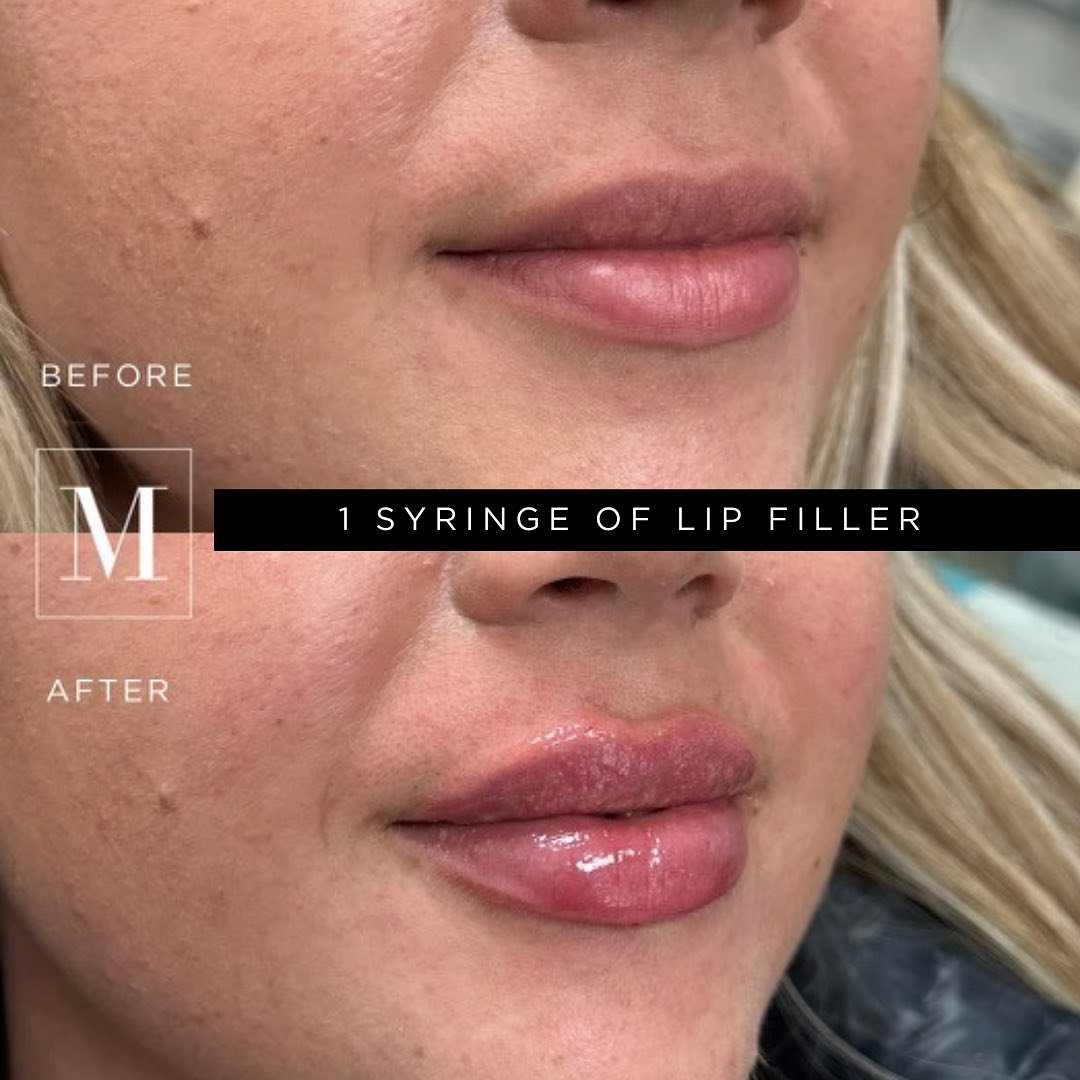 HAPPY FRIYAY! 😘😘

Here&rsquo;s a beautiful and natural lip enhancement down by our talented @nursetiff.monaco ! You can find her at our Mississauga and Burlington location for all of your beauty needs! 💕

We used 1 syringe to get this result. The 