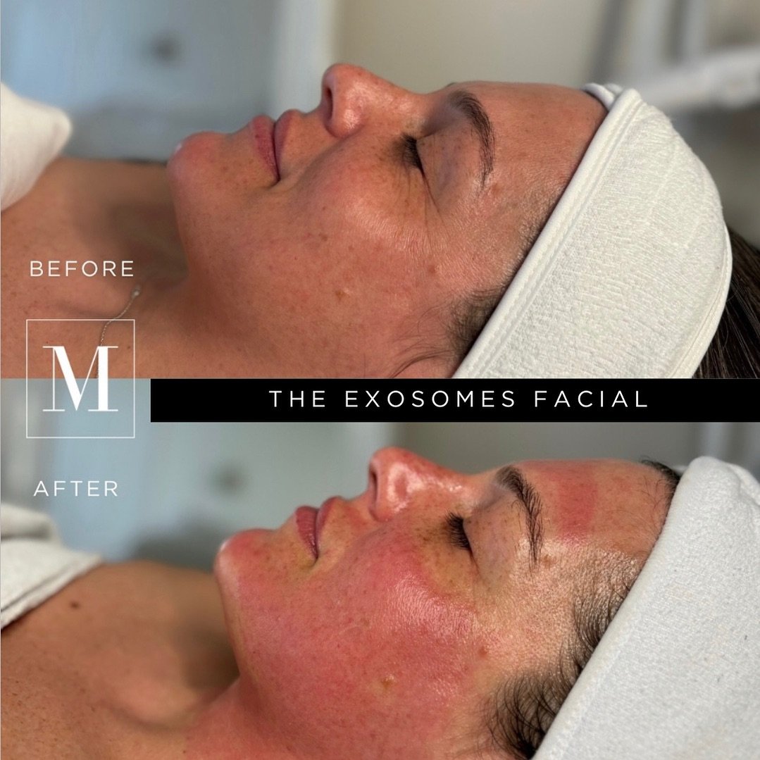 One of our most loved and popular facial treatments&hellip;.the Exosomes Facial 💕. Beautiful results with expected redness immediately seen post procedure. Her skin is glowing 🌟 . Thank you to @shayla.monaco and her beautiful Monaco client for lett