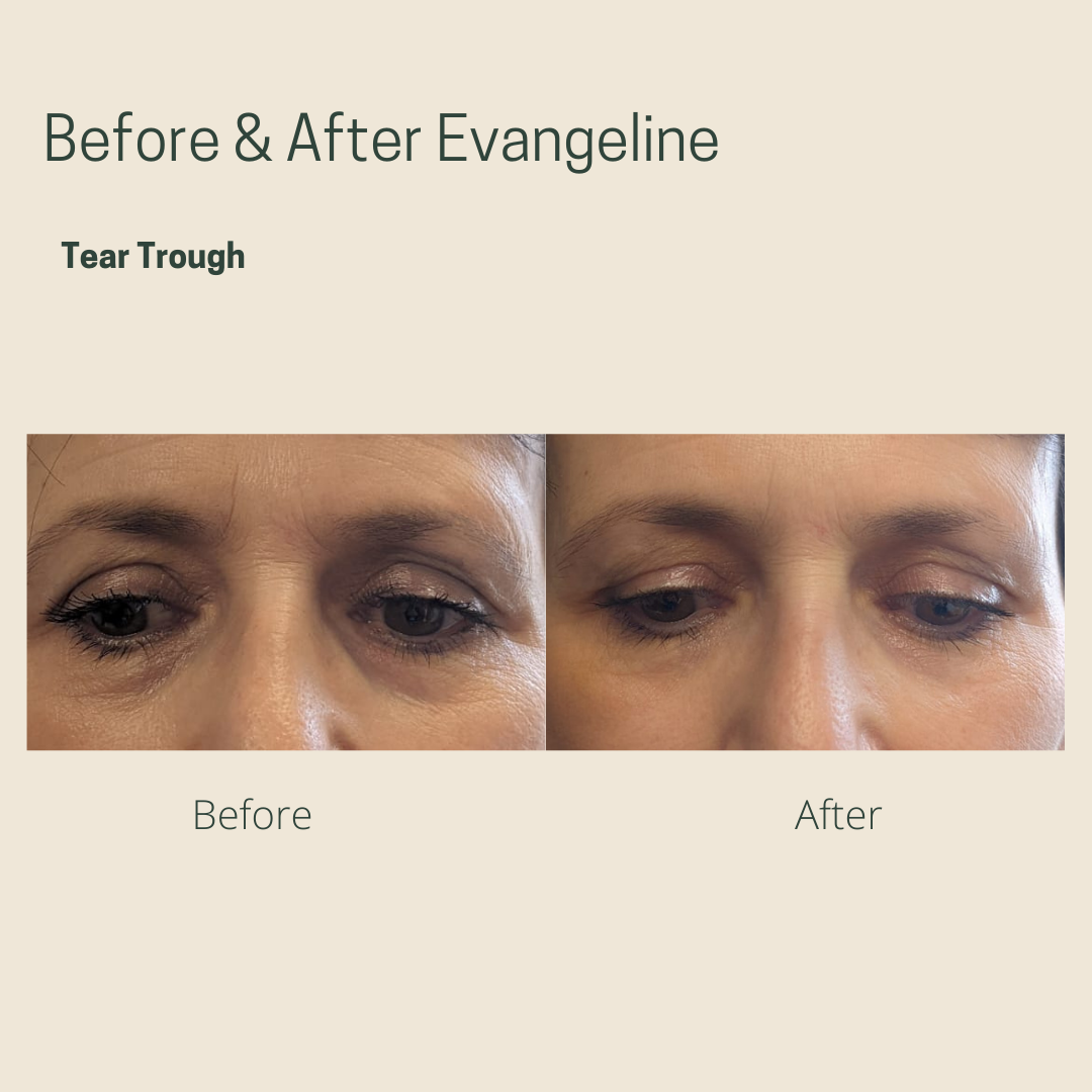 Evangeline Tear Trough-4.png