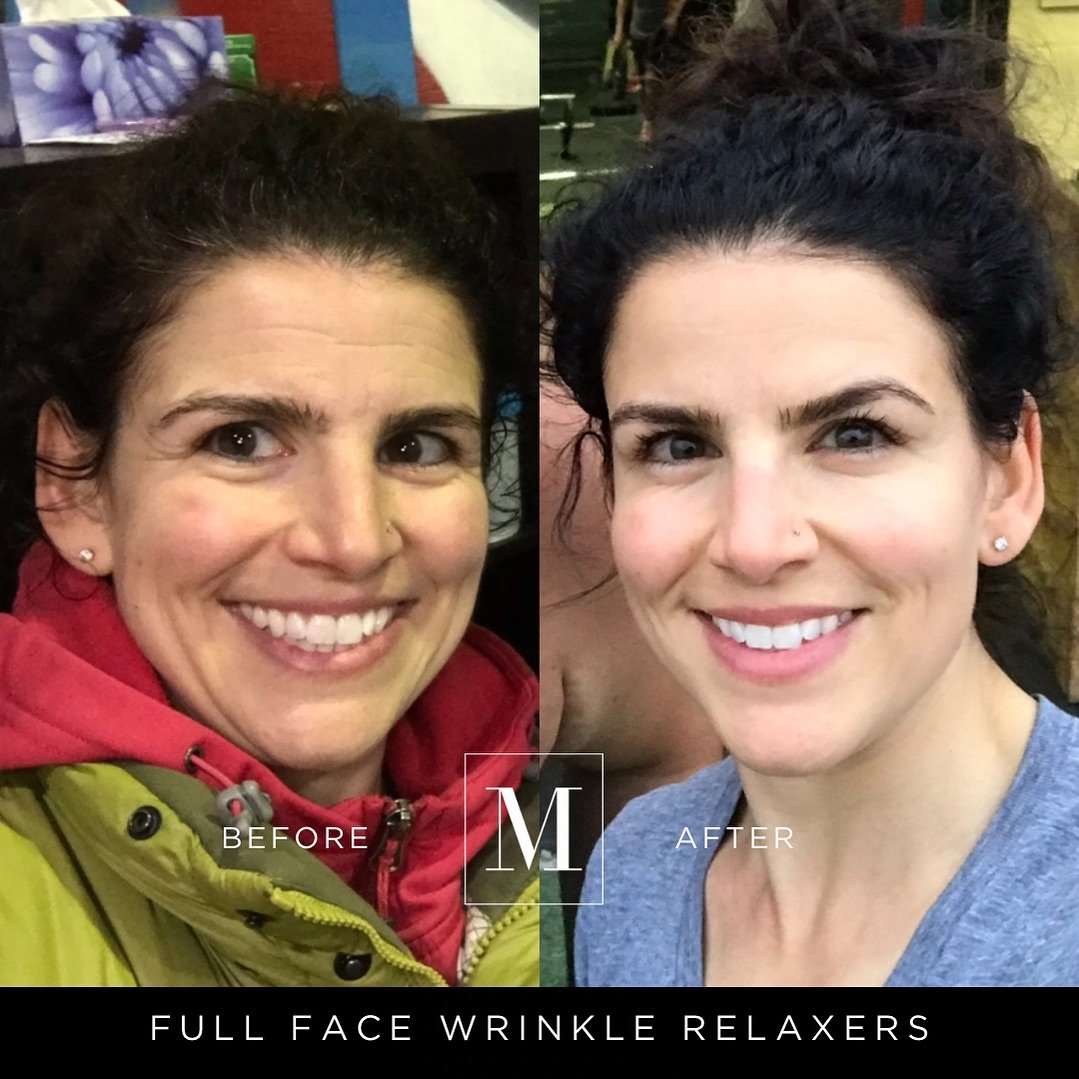 Amazing results for this beautiful Monaco Queen 👸 . She&rsquo;s been coming since 2018 and this was her before and after taken 8 weeks after she got her wrinkle relaxer injections. 

Since then, she&rsquo;s been maintaining regularly to keep her ski