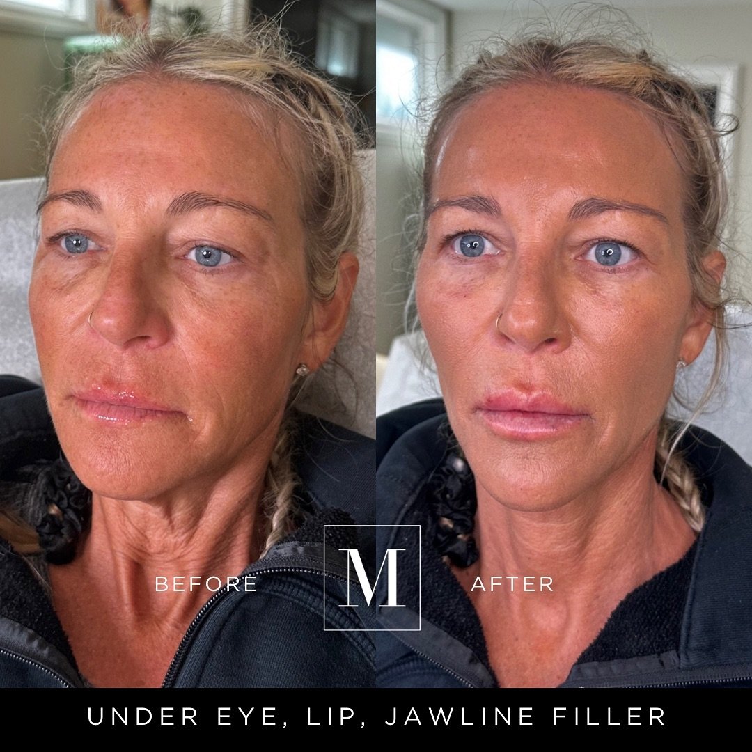 Happy Sunday Monaco Babes!!! 💕💕

Monaco Glow Up done at our Education Session for this beautiful client of ours. She was looking for a little pick me up under her eyes, to reduce the appearance of jowls, project her naturally recessed chin, reduce 