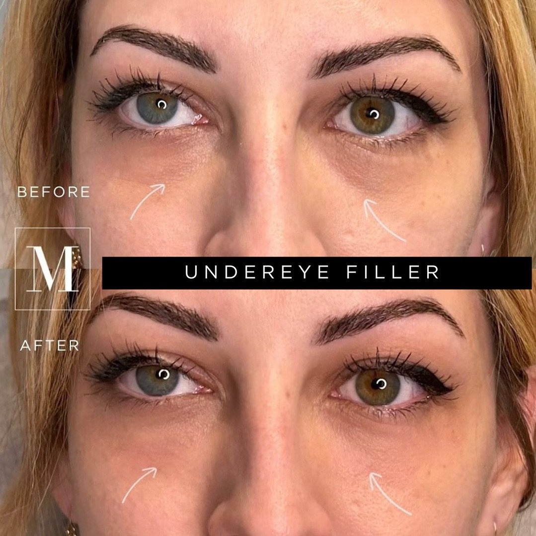 Transforming tired eyes to refreshed radiance ⭐️ 💫 

Treatment: Under eye filler 
Nurse: @nurseash_monaco

It&rsquo;s crucial to exercise conservative dosing in this area due to the hydrophilic nature of the filler, which absorbs water within two w