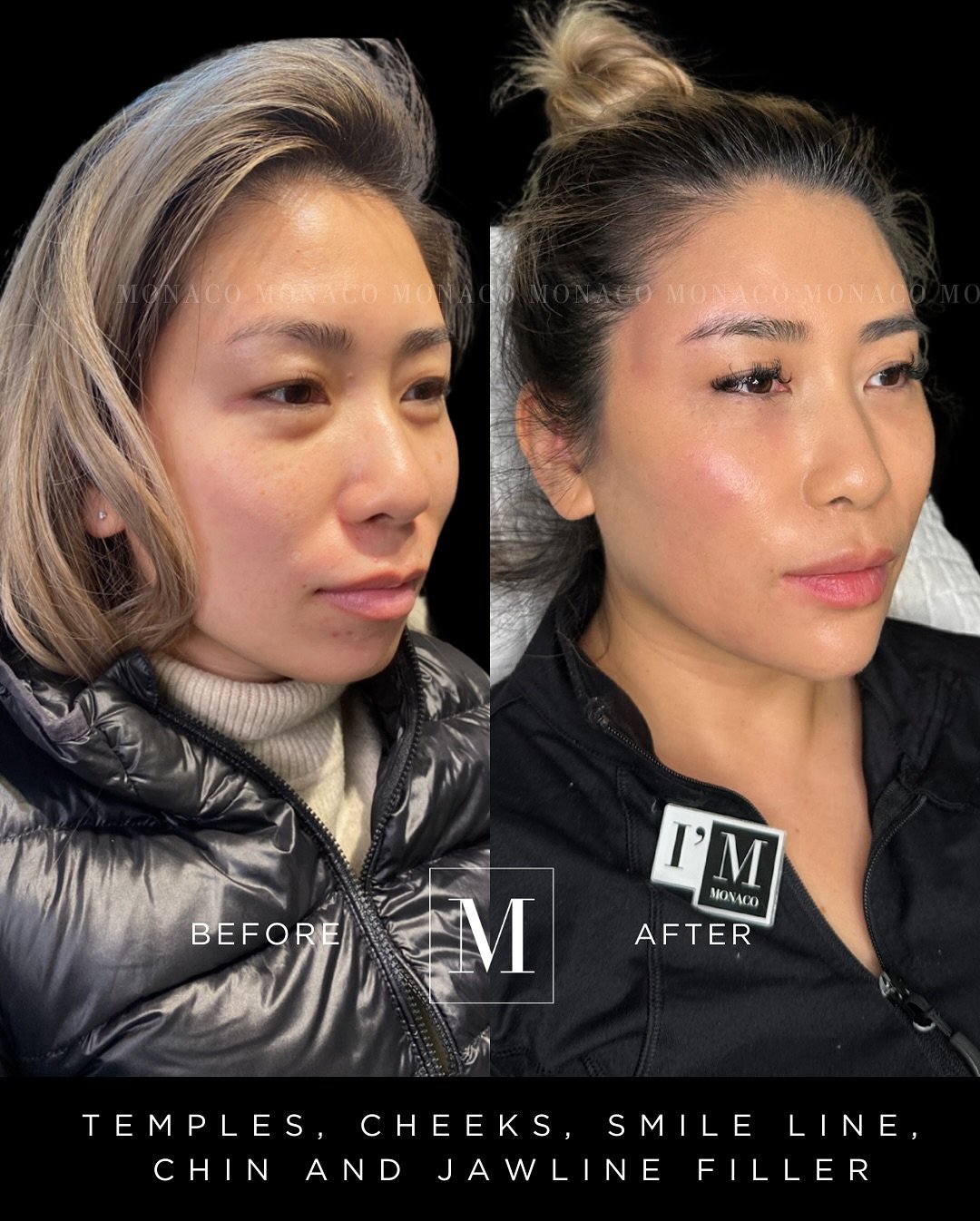 Who&rsquo;s this baddie??!?! 😍😍😍

Meet @nursejenny.monaco ! 💉

If you haven&rsquo;t met her yet, you can do so by visiting her in our Ancaster and Dundas locations. 

Nurse Jenny started her filler journey years ago before becoming a nurse inject