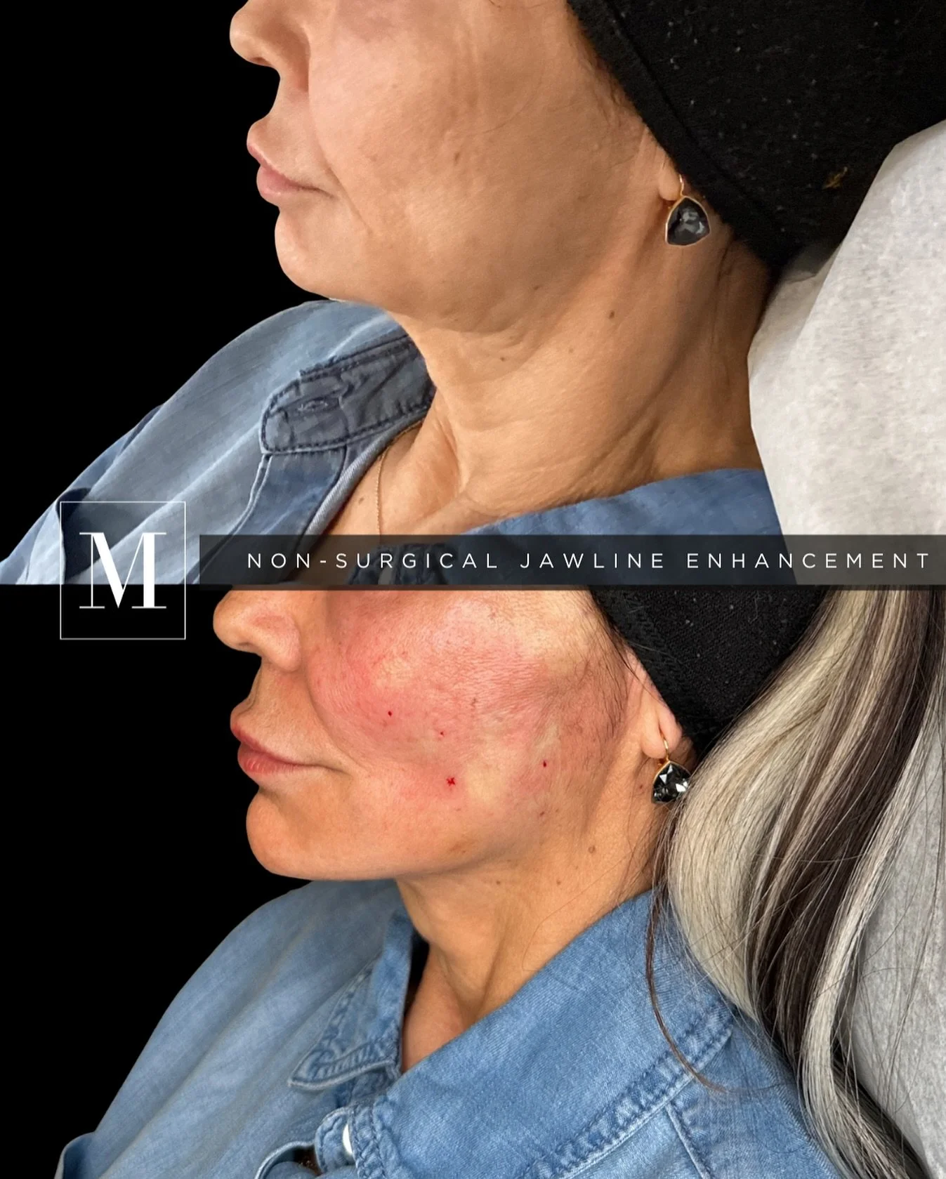 ✨💖 Jawline Goals! 💖✨

Check out this stunning transformation of our gorgeous Monaco babe! 🌟 With a little help from dermal fillers for contouring, Sculptra for that natural lift, absorbable sutures, and the magic of Morpheus8, we&rsquo;ve sculpted