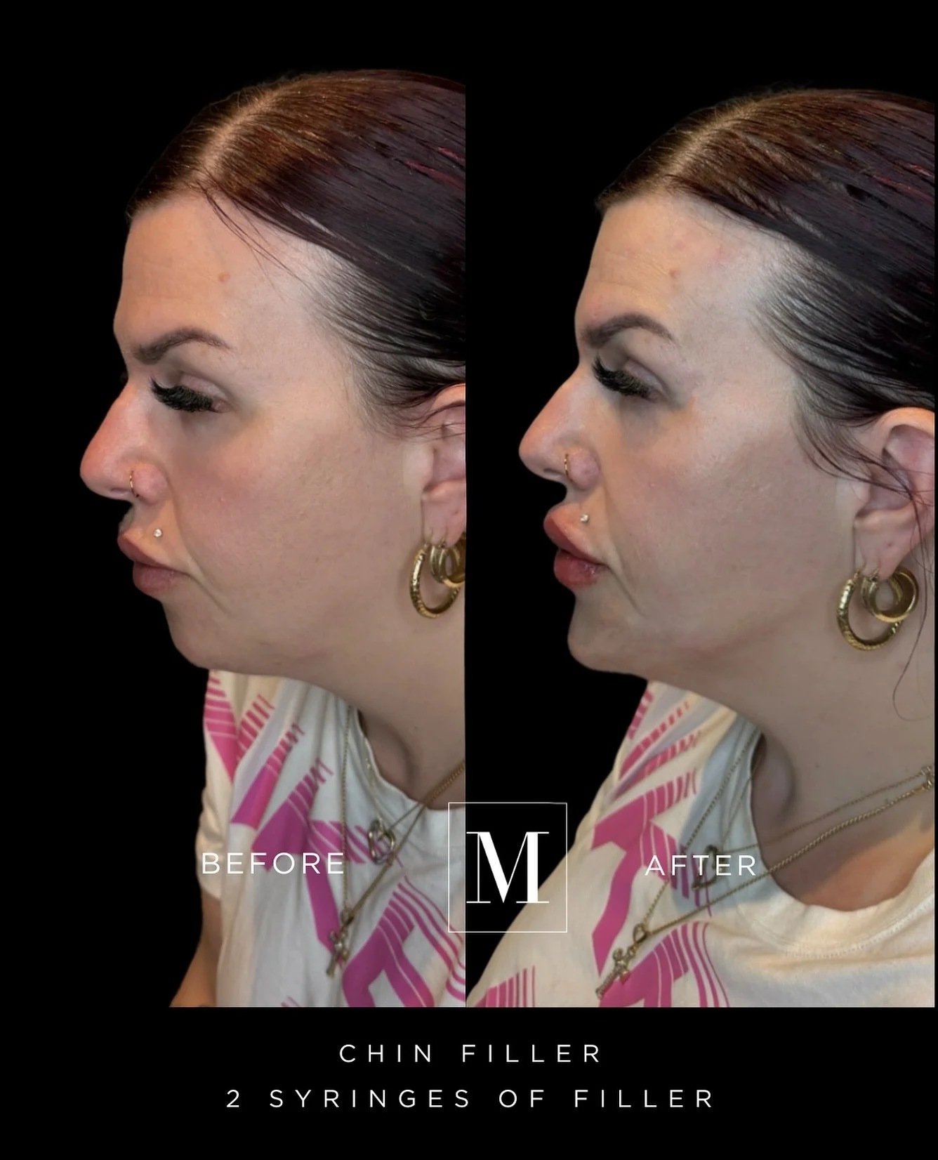Let&rsquo;s talk chin fillers and chin recession 💉❤️ 

As a professional in the beauty industry, I know that our facial proportions play a huge role in how we perceive ourselves. A recessed chin can sometimes make the jawline appear less defined, le
