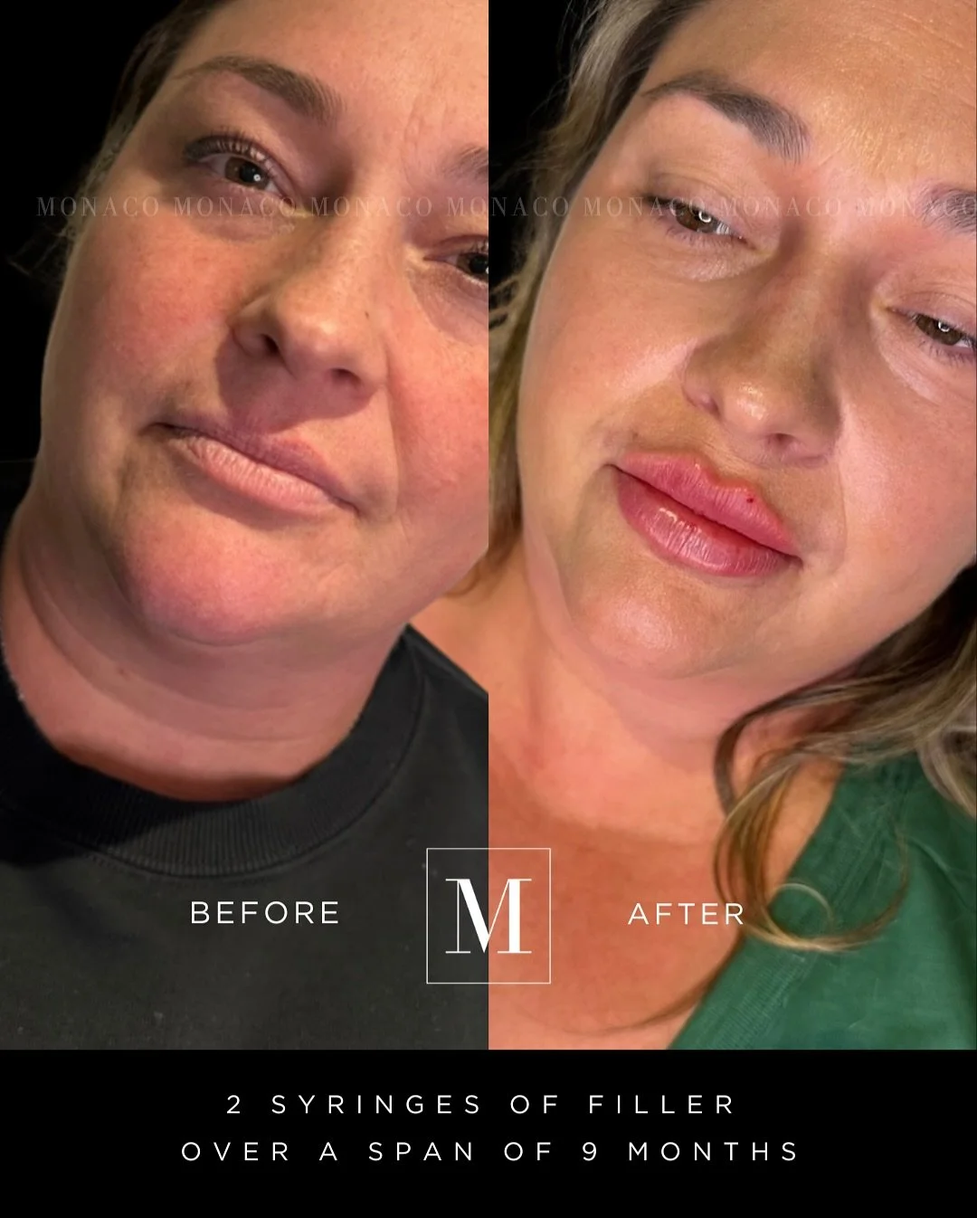 Obsessed with our Monaco babe&rsquo;s results for a perfect pout 😍😍. 

From her before photo to current, there was a 9 month span in which two visits were done with one syringe injected at each visit. Our beautiful client spread out her lip filler 