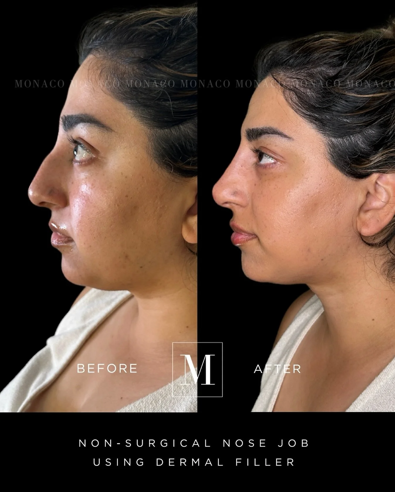 ✨ A non-surgical nose job for this beautiful mama today ✨ 
😍😍😍😍

Nose filler is an excellent modality to mask the dorsal hump on the nose to creates a straighter and more contoured appearance to the nose.

Nose filler can often give  the illusion