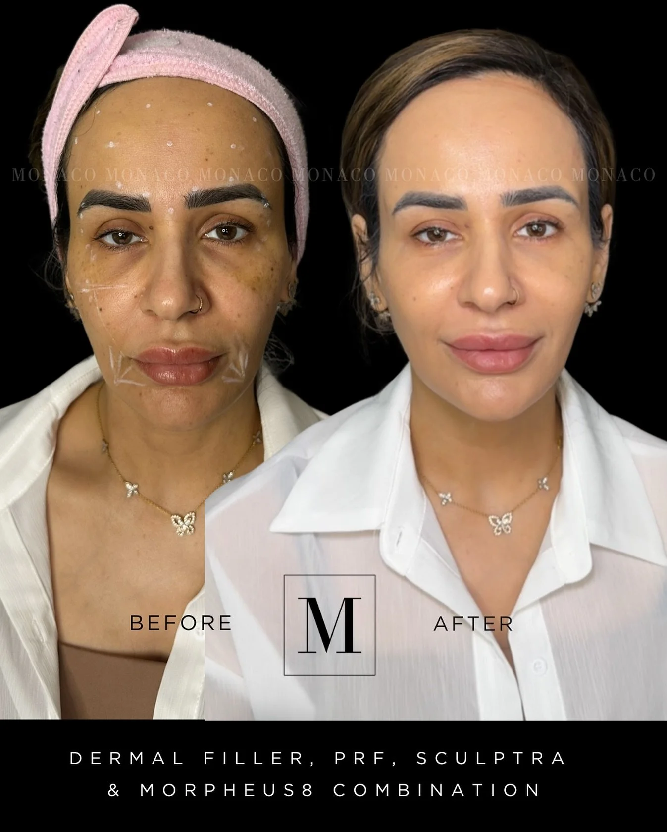 🌟 Absolutely in love with this stunning glow-up, expertly crafted by our talented duo, @nursean.Monaco and @jen.monaco, during our latest educational session! 💖✨

This transformation showcases the power of multi-modal approaches in aesthetic treatm