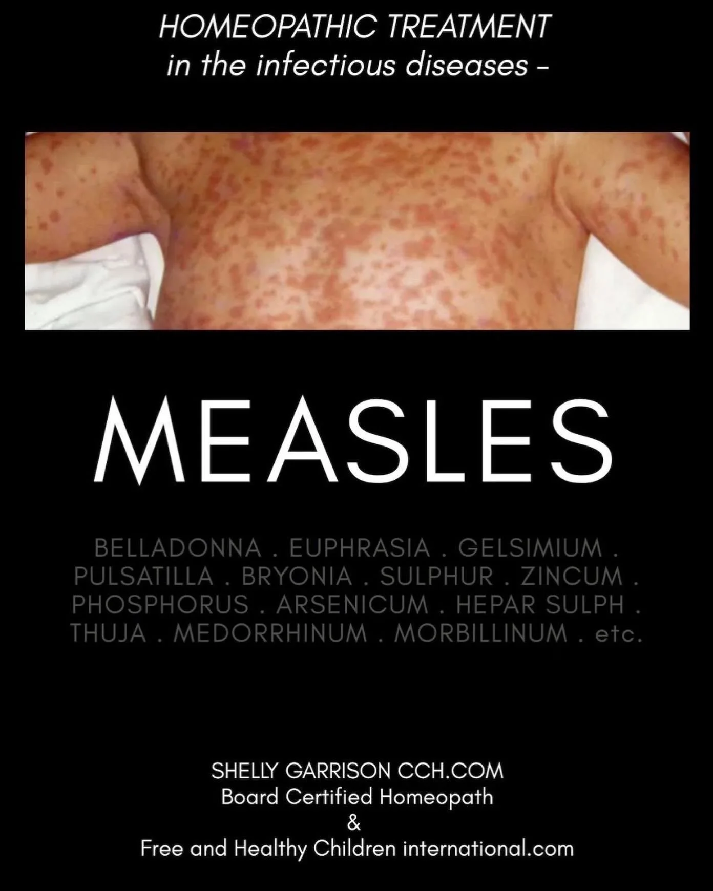 MEASLES

Homeopathy and the Infectious Diseases - MEASLES

.

Basic Understanding -

Measles, also known as rubeola or seven-day measles, is a highly contagious viral epidemic illness caused by the morbillivirus, which is spread by droplet infection 