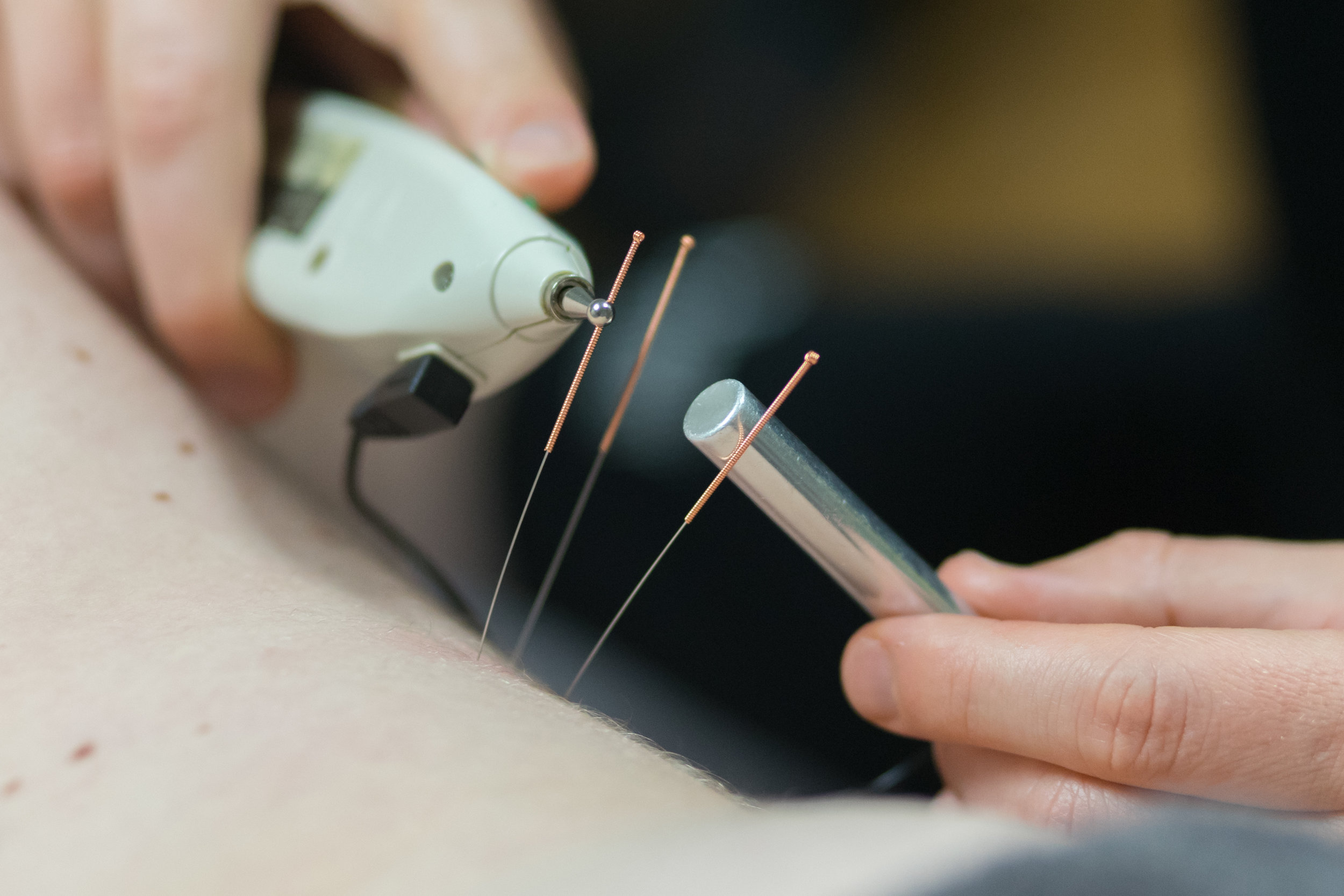 Dry Needling &amp; Acupuncture
