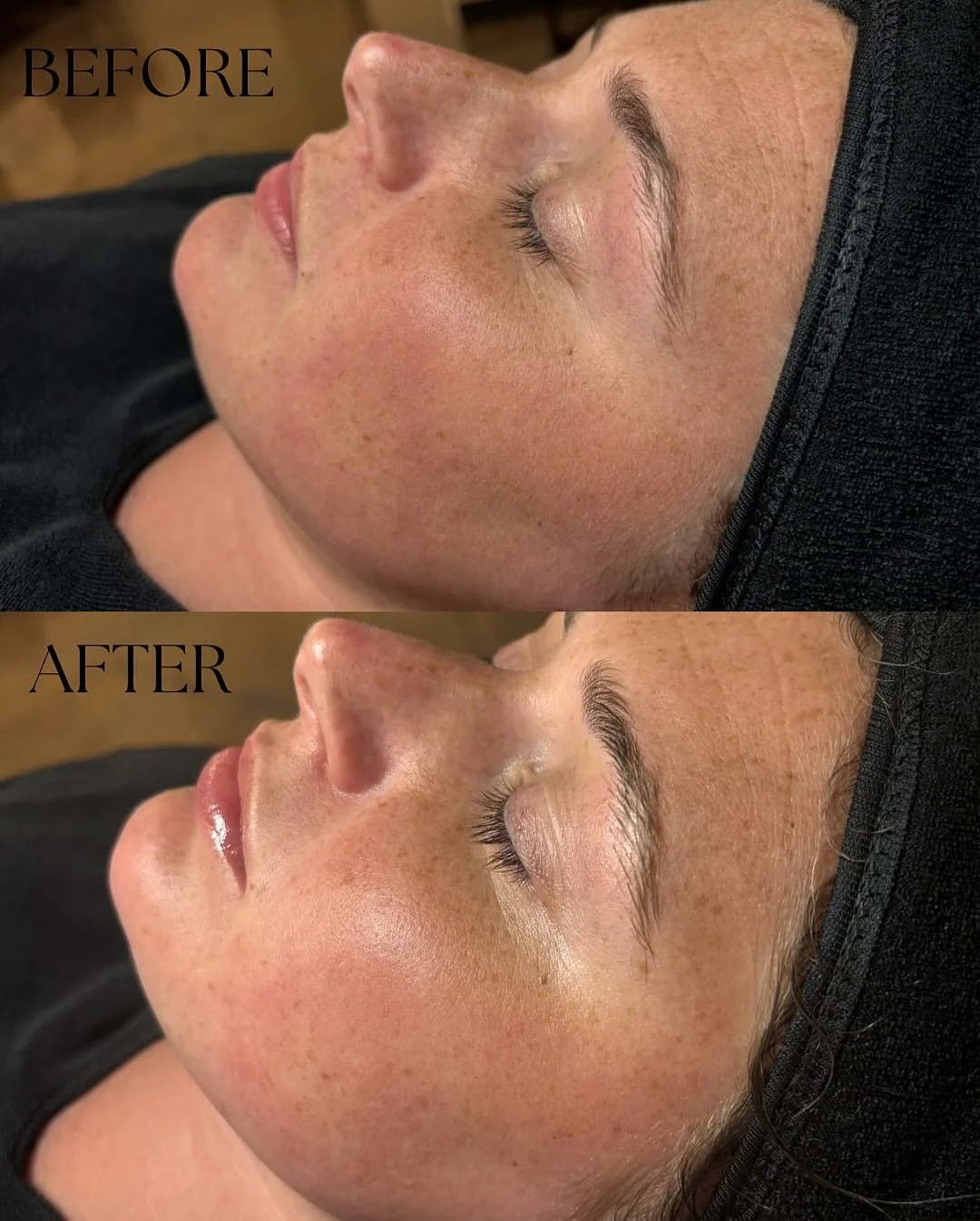 ✨ Wedding week glow ✨

Dermaplaning is one of the best facials to book right before your big event! It instantly smooths, brightens, removes peach fuzz + dead skin so your makeup lays flawlessly and your skin looks fresh in every photo. 💍📸

Perfect