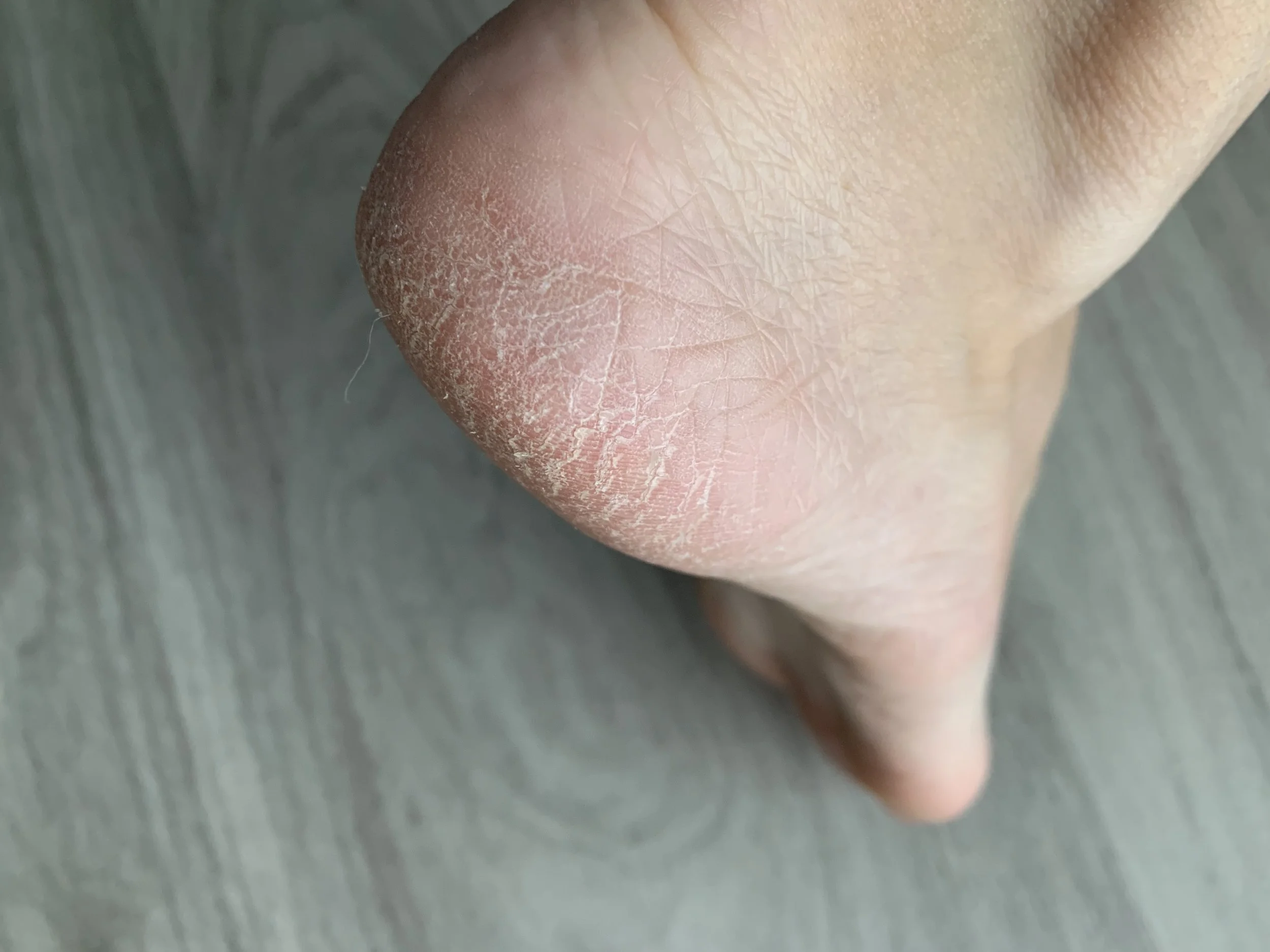 Before…yikes. And yes, I realize there is something stuck to my foot. Thats how dry they were!