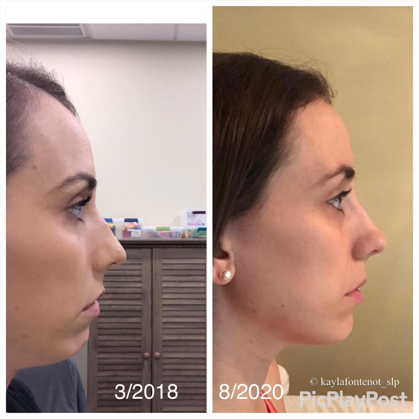 Swipe for before/after myofunctional therapy photos. 😳 Yes, these are my personal photos. Chronic allergies, full time mouth breather, and a chin so recessed that I once considered surgery. 
.
When I took the first before photo, I was shocked at how