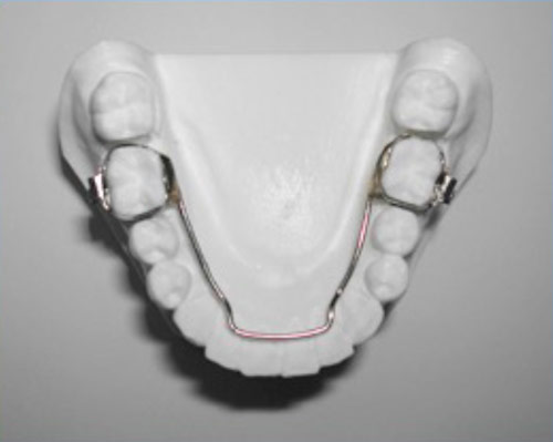 lower-lingual-holding-arch.jpg