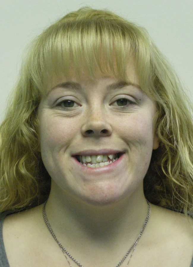 Tiffani C. Before Orthodontic Treatment