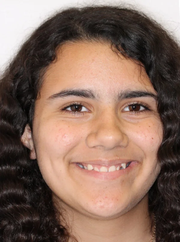 Alexa H. Before Orthodontic Treatment
