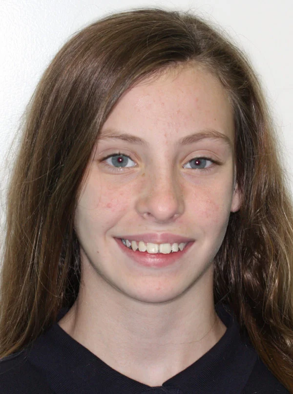 Hannah H. Before Orthodontic Treatment