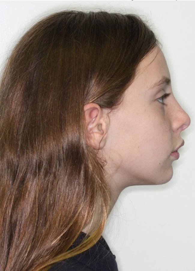 Hannah H. Before Orthodontic Treatment