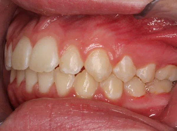Hannah H. After Orthodontic Treatment