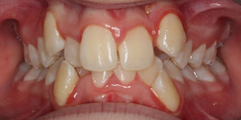 Britney P. Before Orthodontic Treatment
