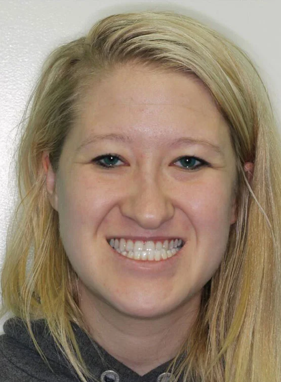 Elena S. Before Orthodontic Treatment