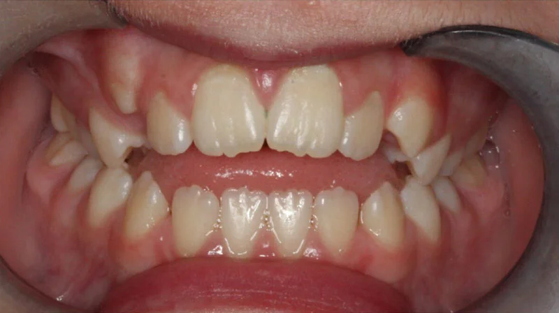 Lauren W. Before Orthodontic Treatment